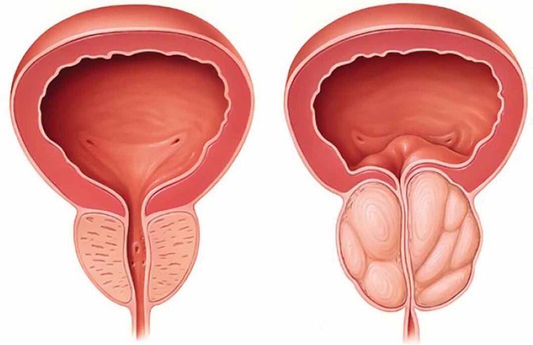Prostată normală și inflamația prostatei (prostatita cronică)