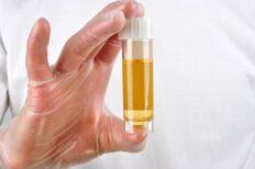 Analiza urinei este una dintre metodele de diagnosticare a prostatitei