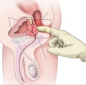 Cancer de prostata: simptome, tratament, prevenire | fanfarapr.ro