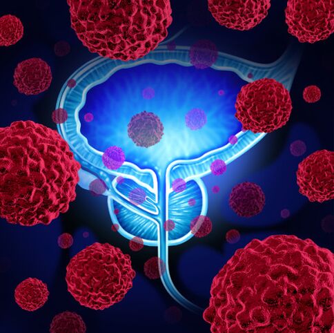 Activitatea microorganismelor patogene este cauza dezvoltării prostatitei