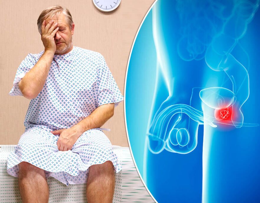 Un bărbat cu prostatită este diagnosticat cu boala